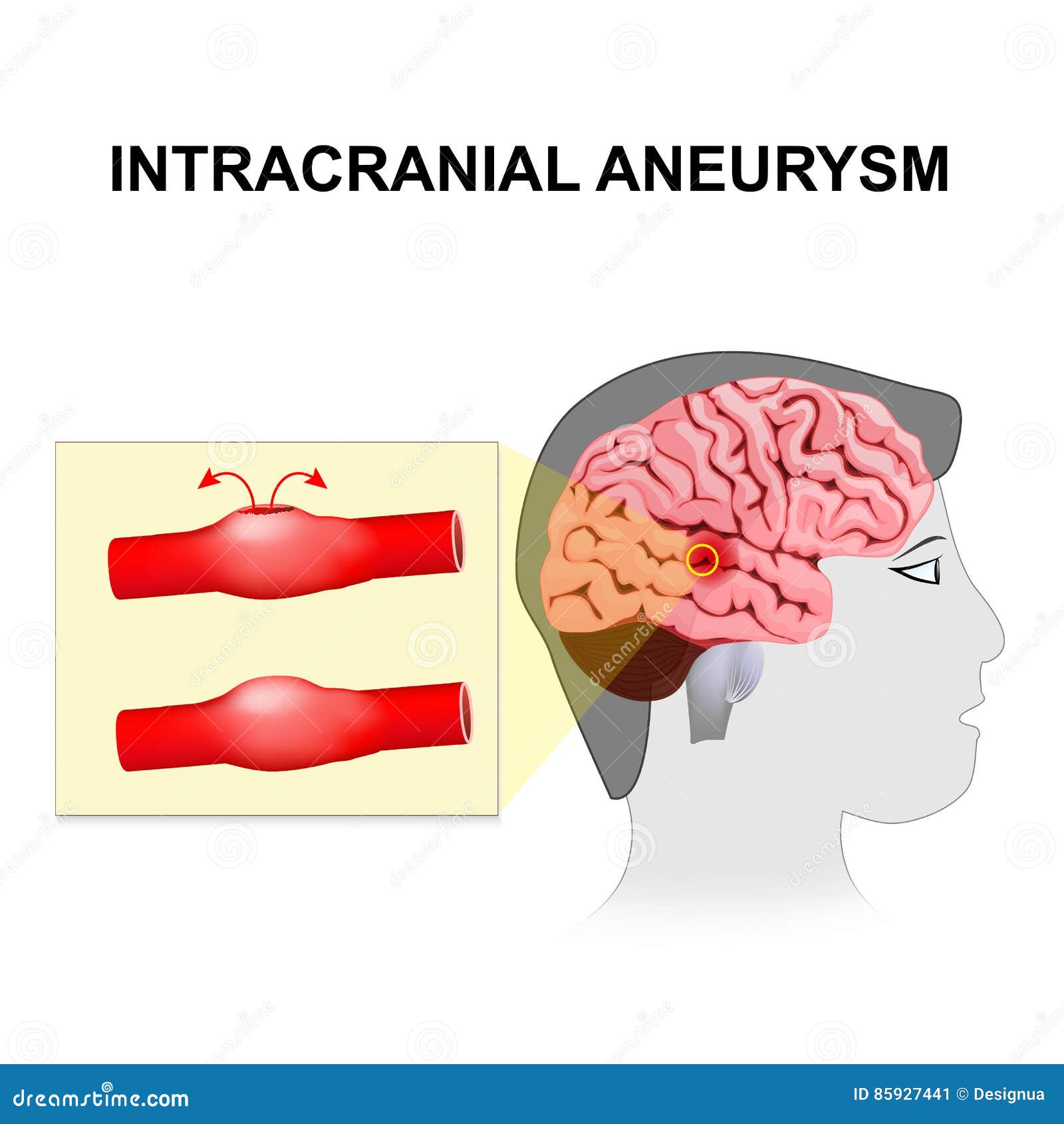 intracranial aneurysm. cerebral or brain aneurysm.