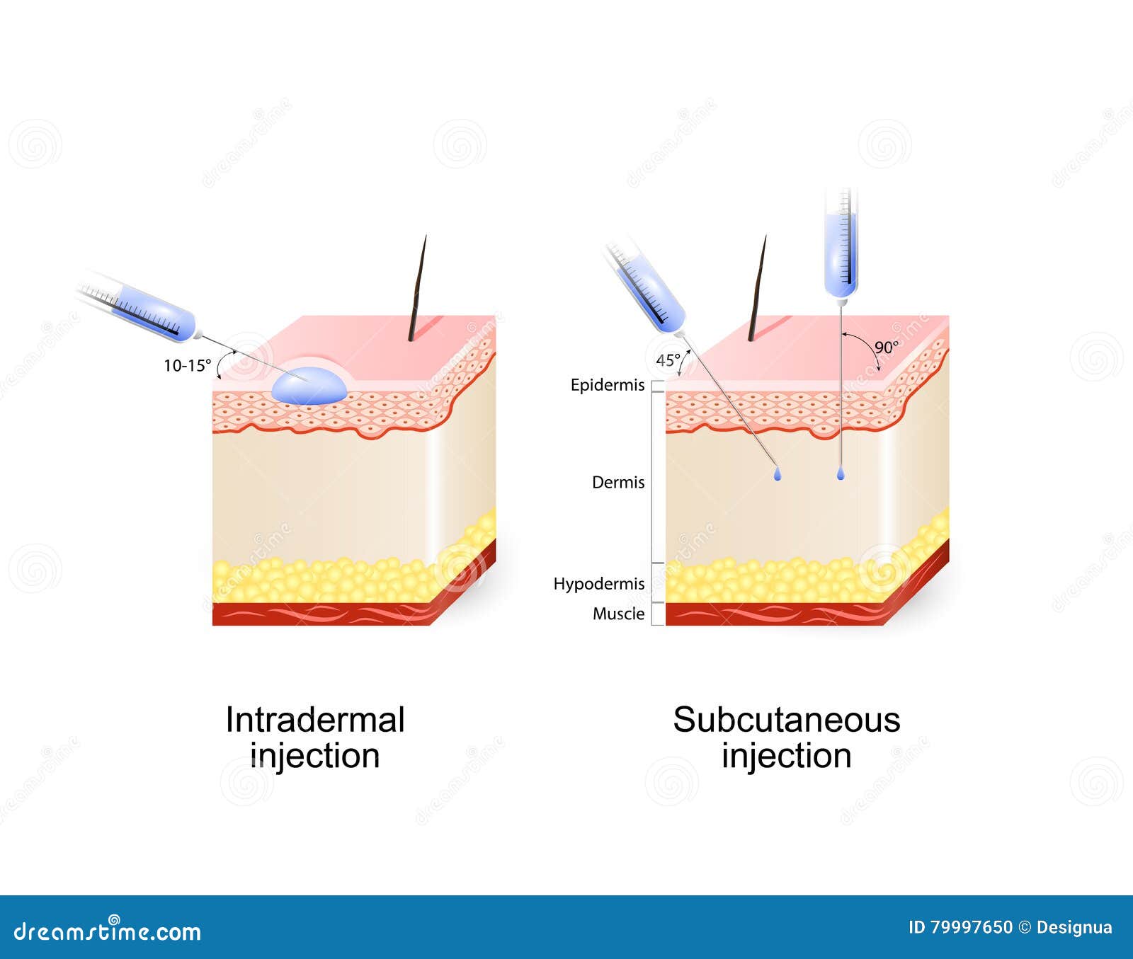 Intradermal And Subcutaneous Injection Vector Illustration