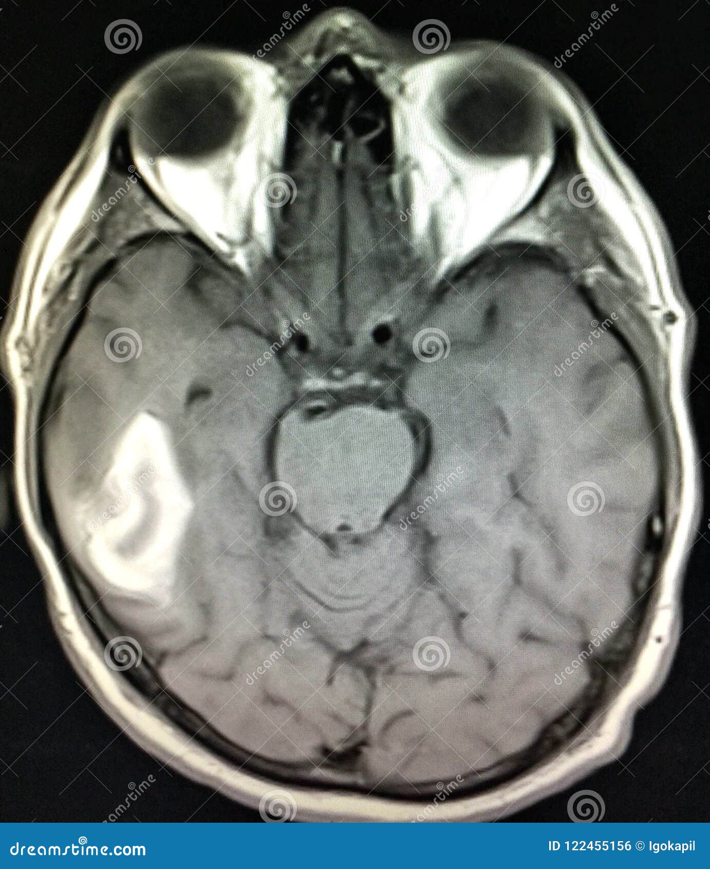 intraparenchymal hematoma brain pathology mri