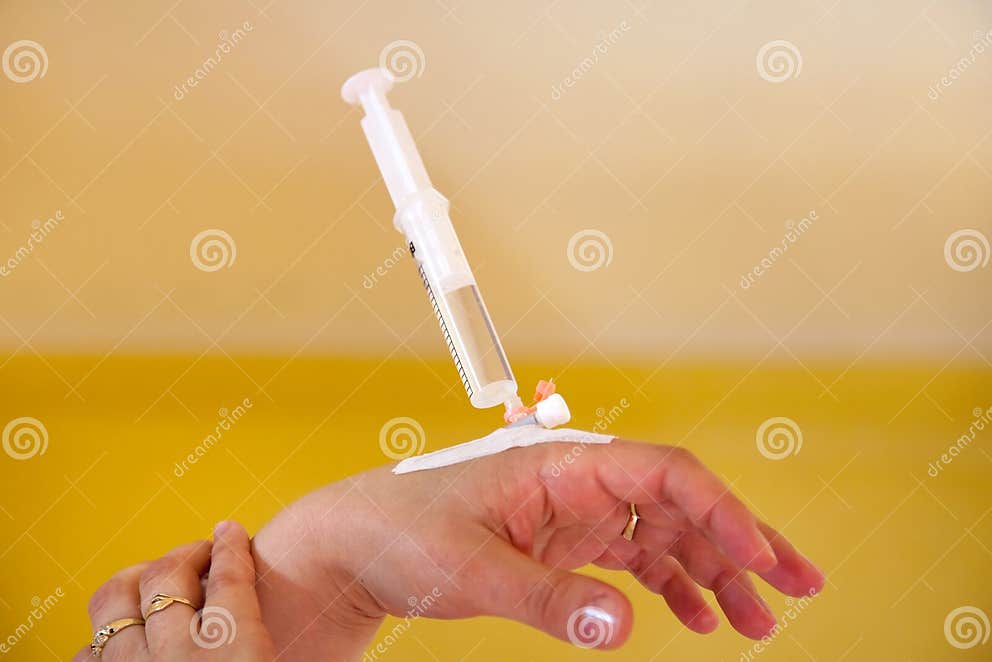 Intravenous calcium dosage stock image. Image of hand 9883425