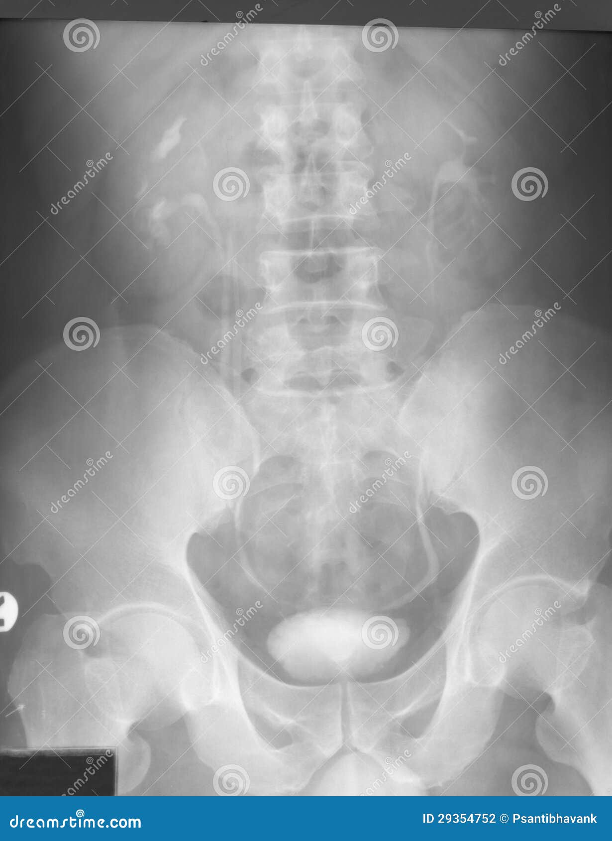 intravenous pyelography (ivp), 10 minutes after urographin injection film, of a 41 years old man, demonstrated enlarge both kidney