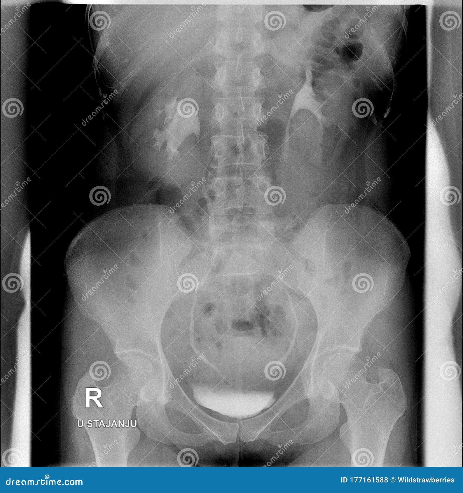 intravenous urogram. erect position. no filling defects within the ureters.