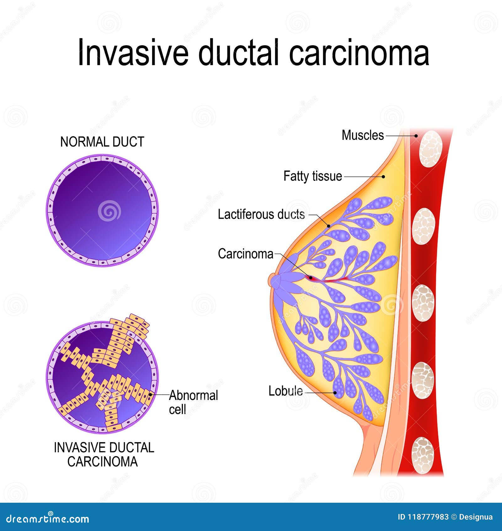 invasive ductal carcinoma