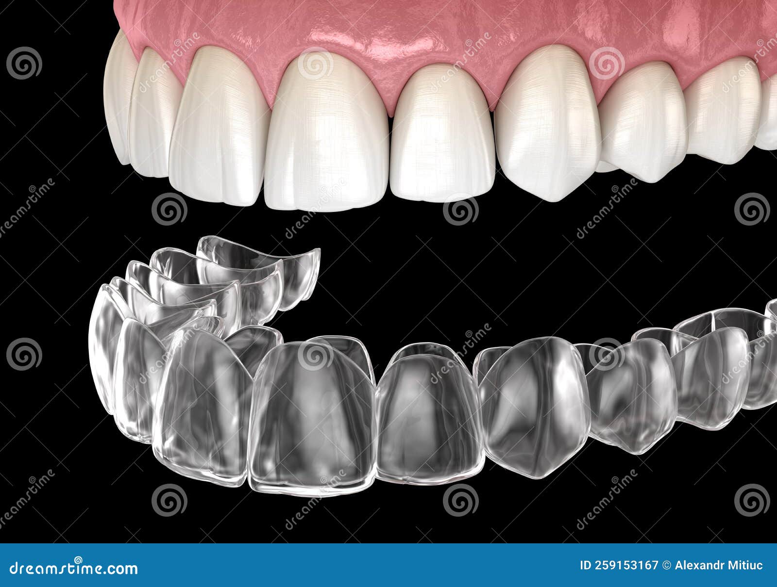 invisalign braces or invisible retainer. medically accurate dental 3d 