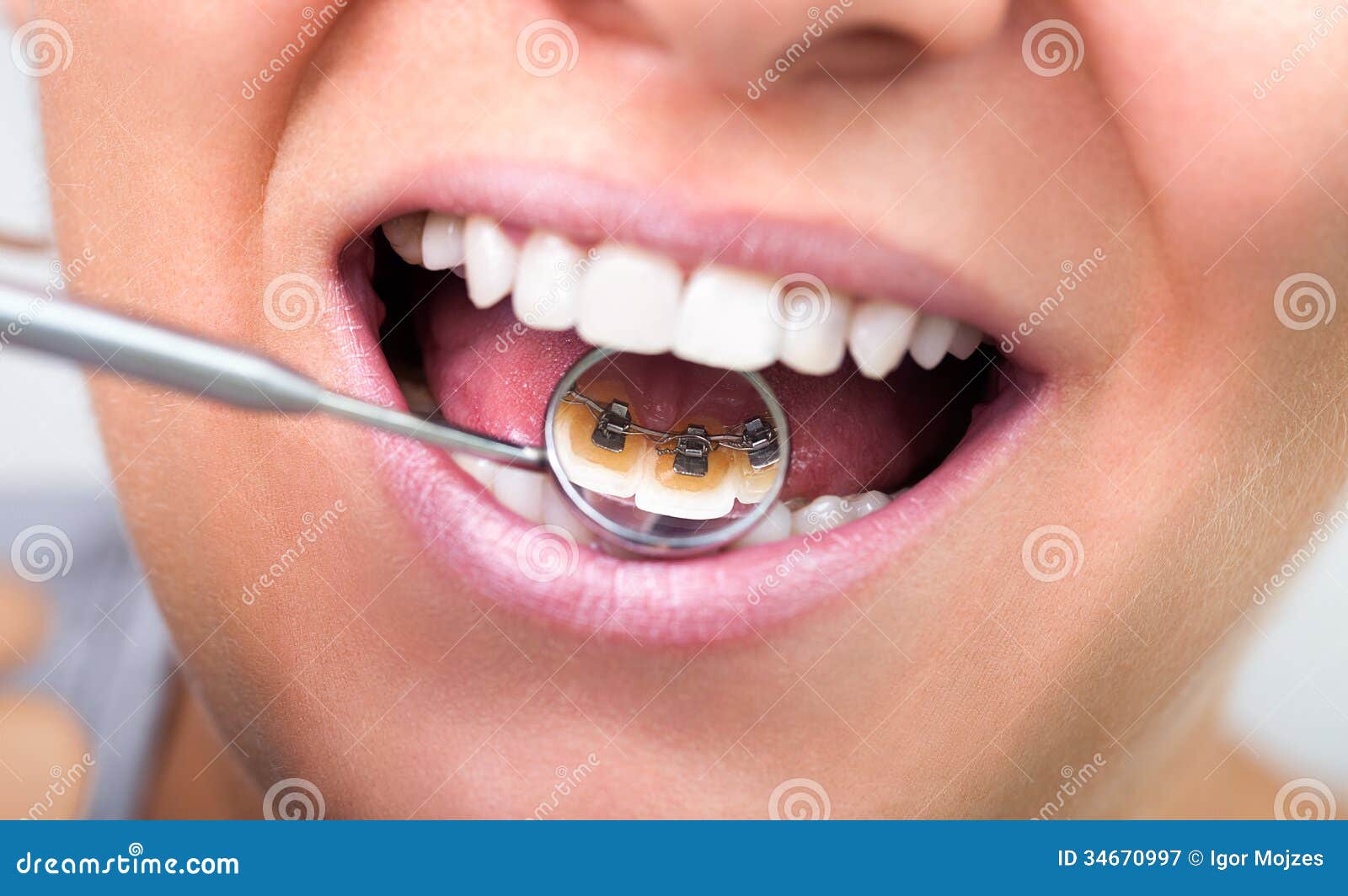 Invisible lingual braces stock image. Image of health - 34670997