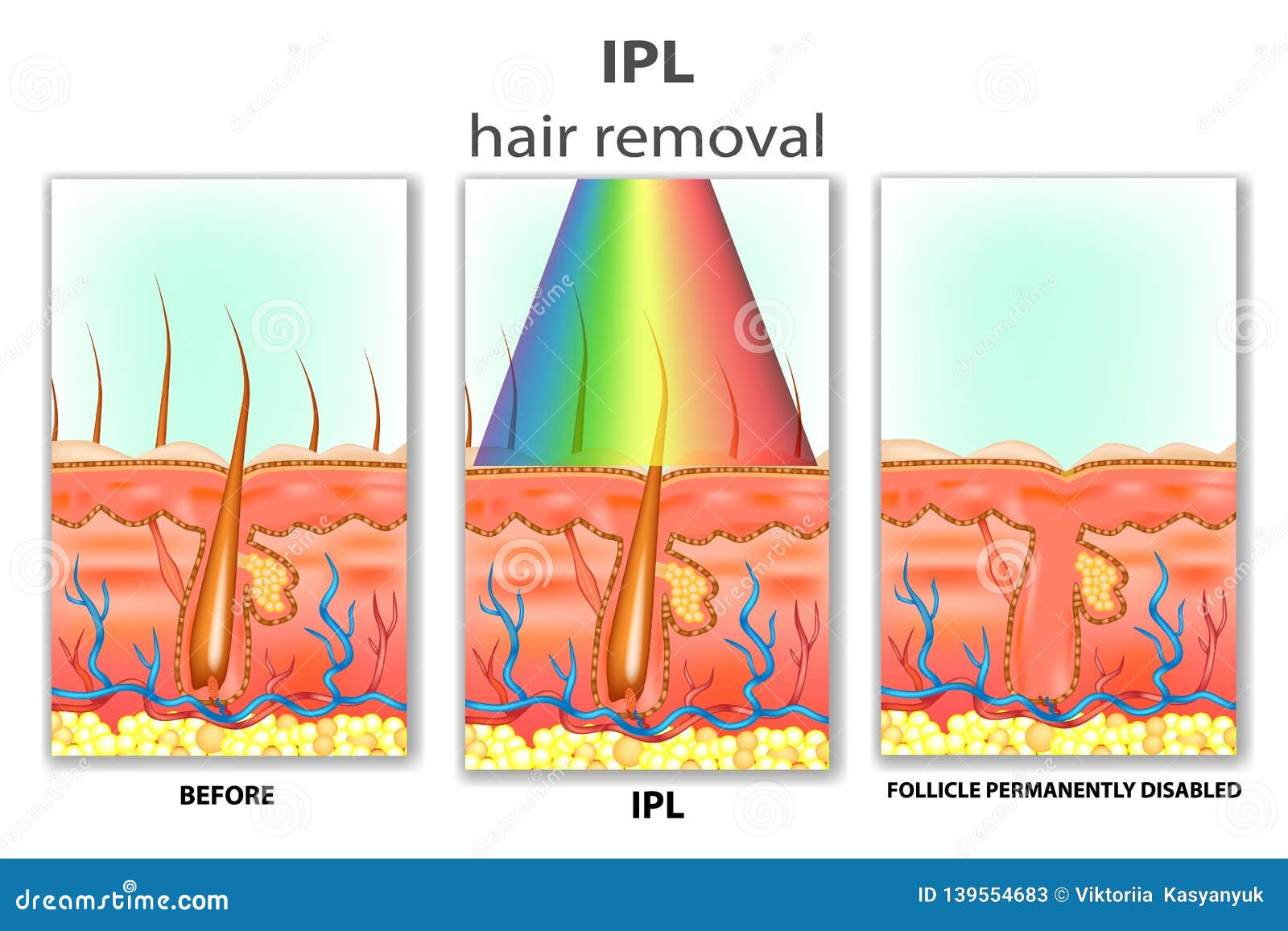 IPL Intense Pulsed Light stock vector. Illustration of skin - 139554683 IPL Intense Pulsed Light stock vector. Illustration of skin - 139554683