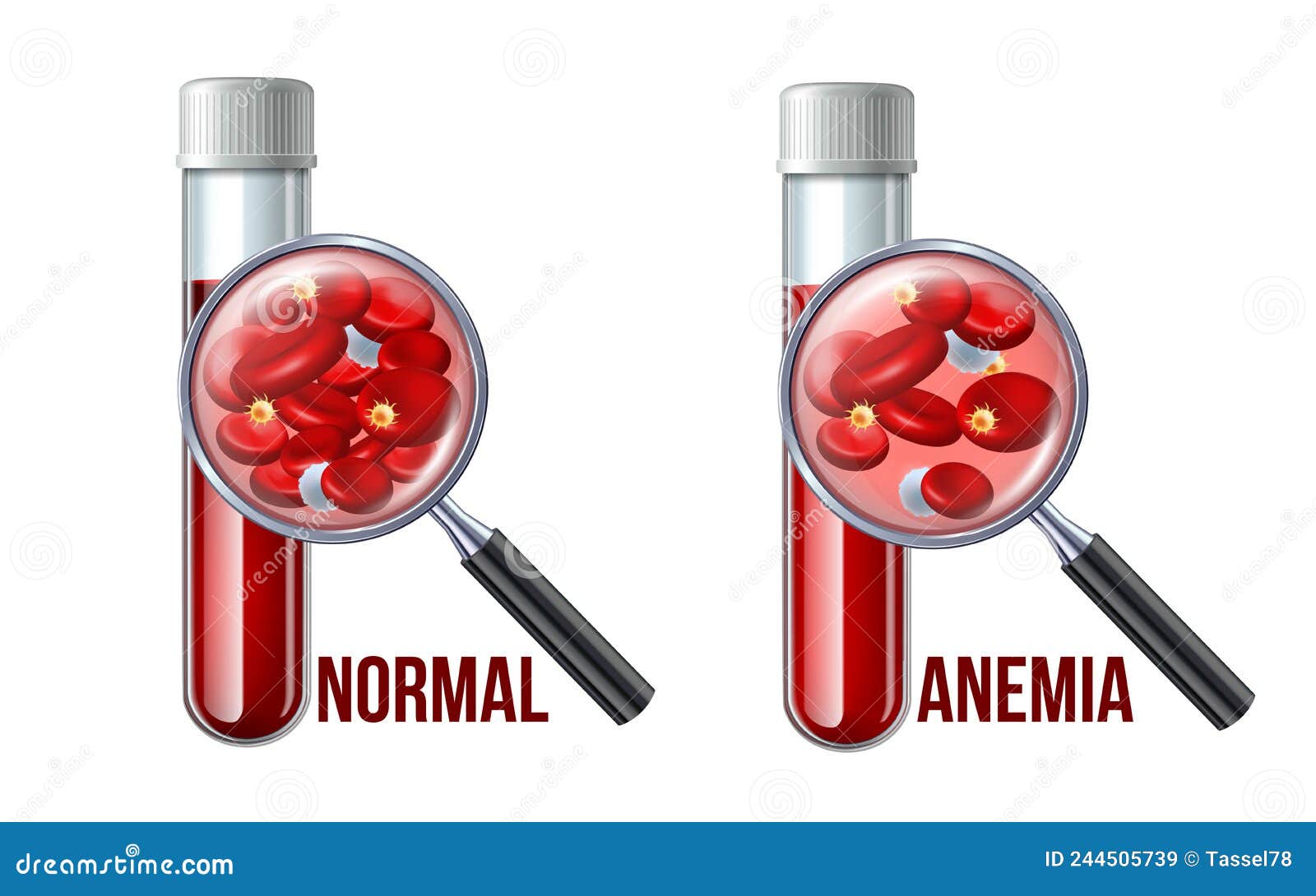 Symptoms Iron Deficiency Stock Illustrations – 100 Symptoms Iron Deficiency  Stock Illustrations, Vectors & Clipart - Dreamstime