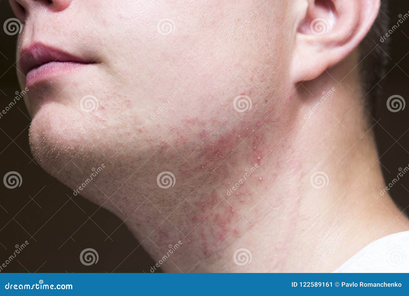 Irritation after shaving Irritation after shaving