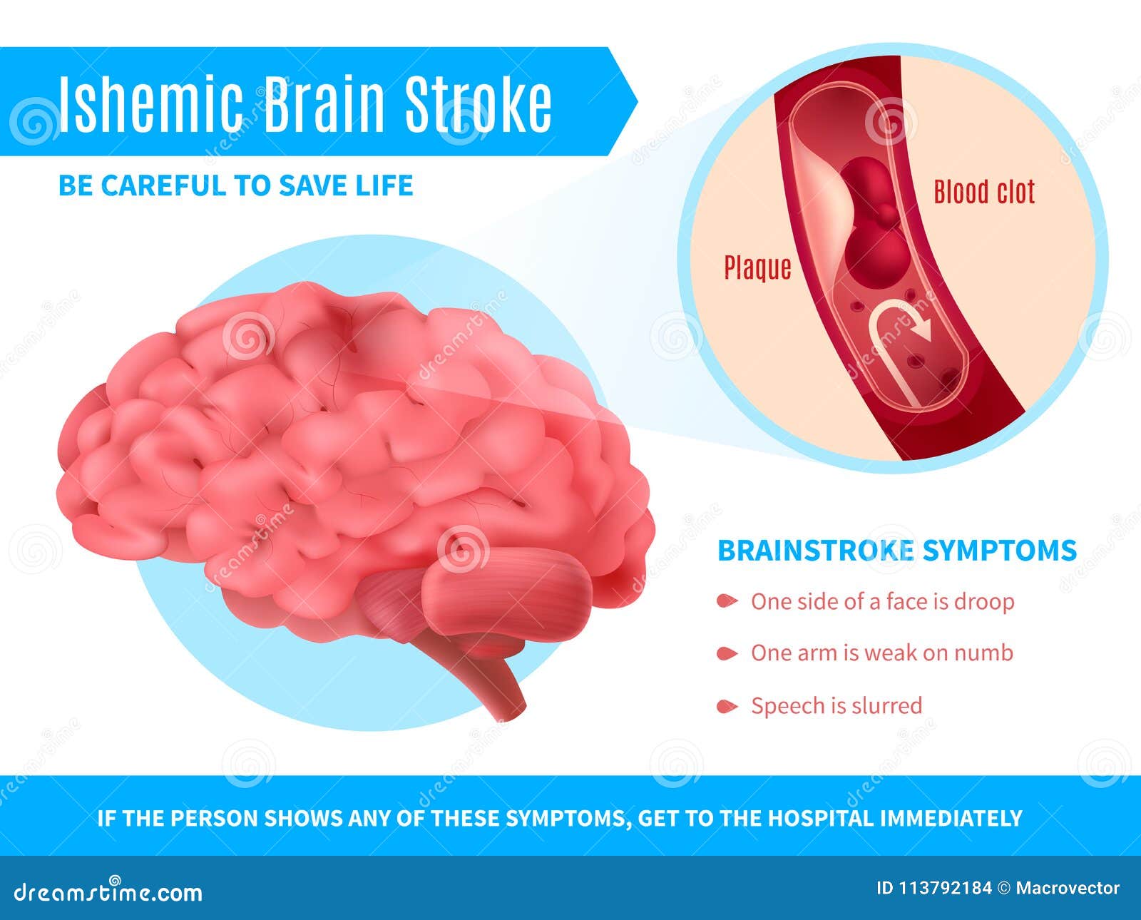Ischemic Stroke System Disorder Template Ischemic Stroke System Disorder Template