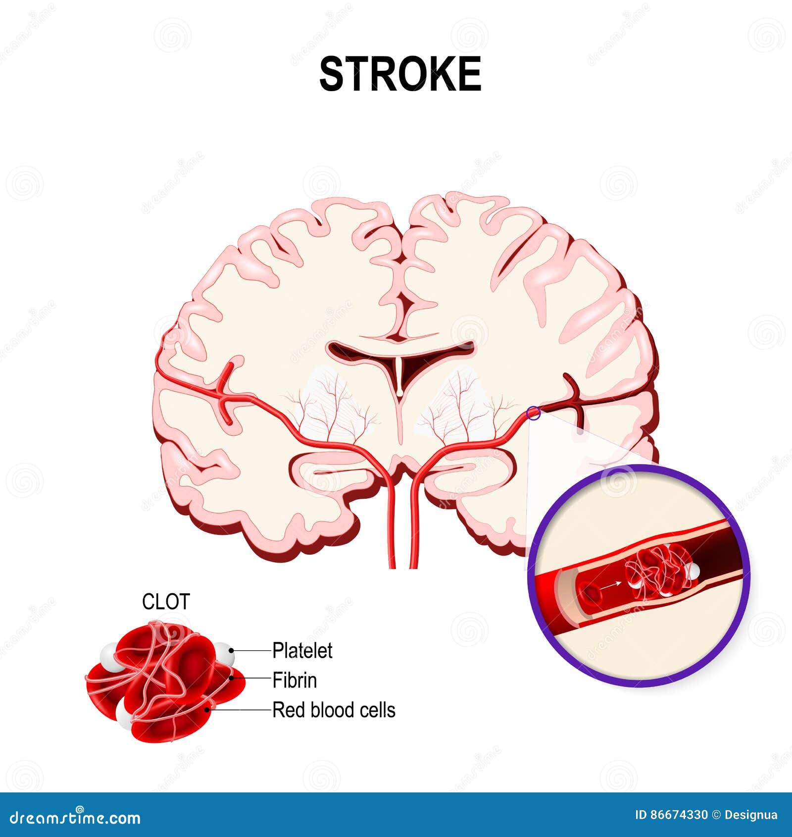 Ischemic Stroke Of Brain Icon Cartoon Vector 211939395