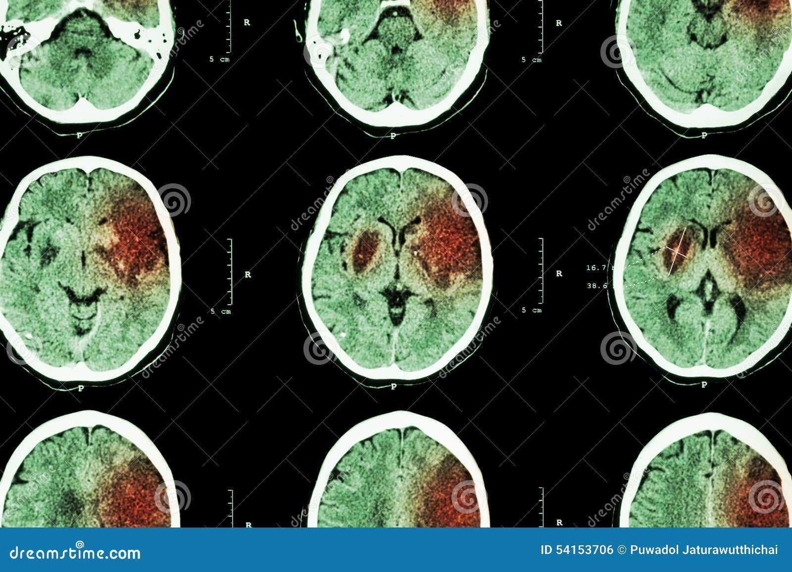 ischemic stroke : ( ct of brain show cerebral infarction at left frontal - temporal - parietal lobe ) ( nervous system background