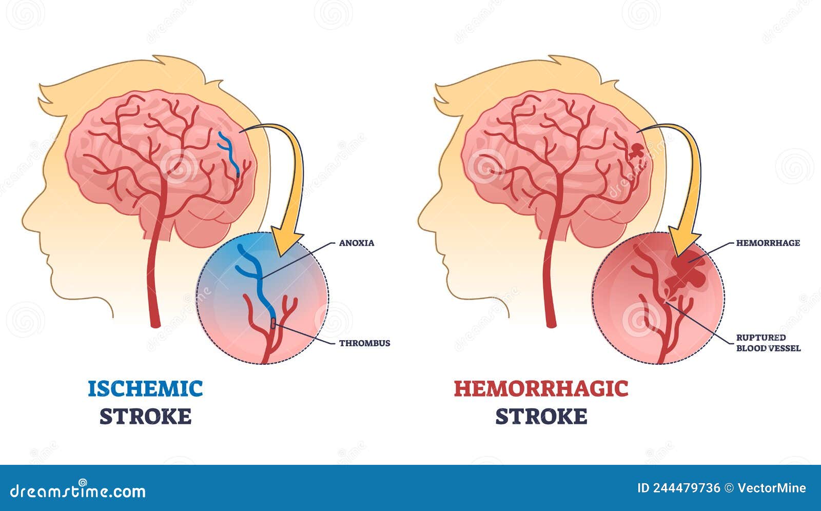 ischemic stroke vs hemorrhagic stroke