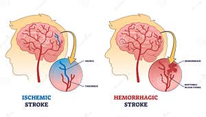 Ischemic Vs Hemorrhagic Head Stroke Anatomical Comparison Outline 