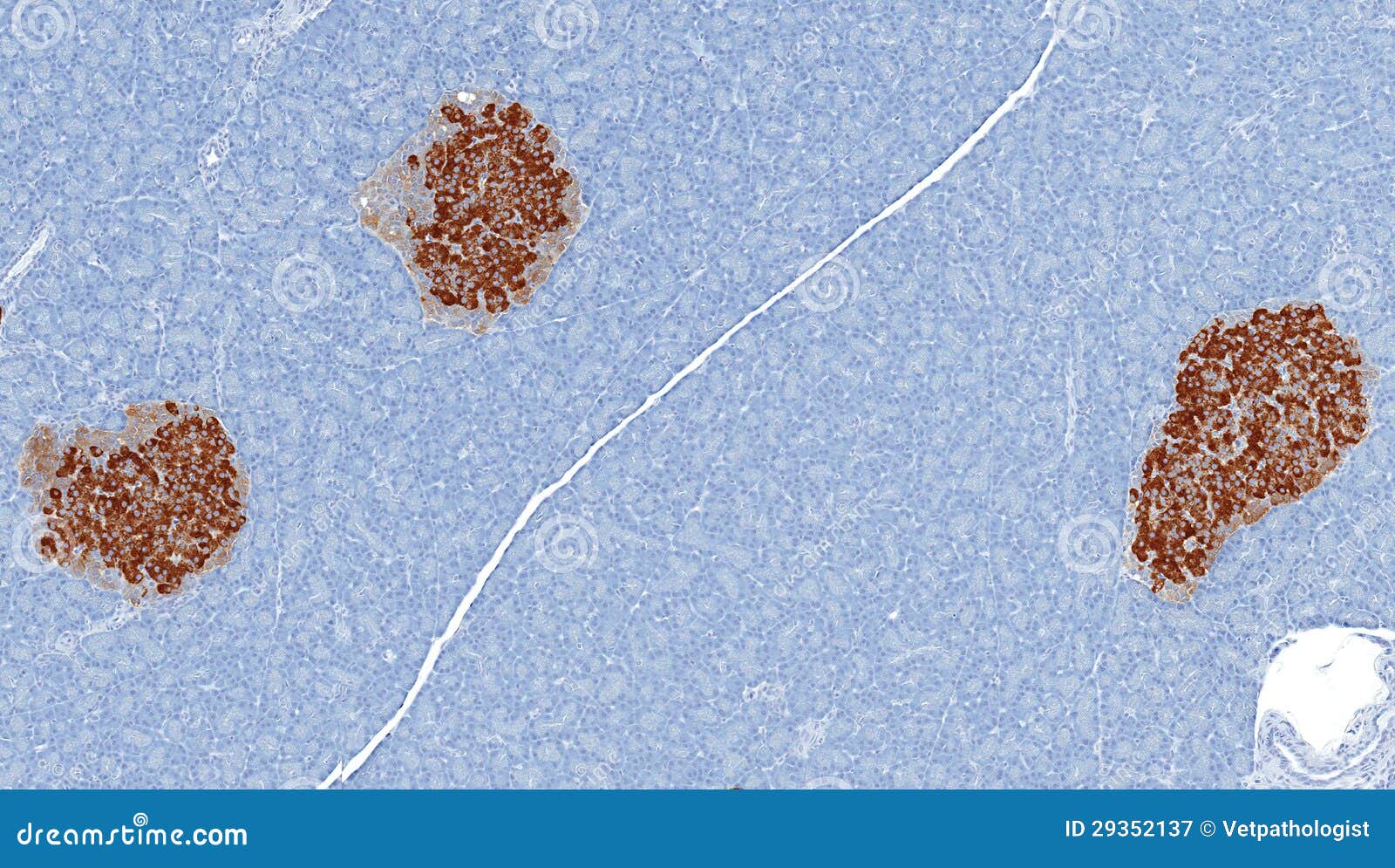 islets of langerhans stained brown for insulin