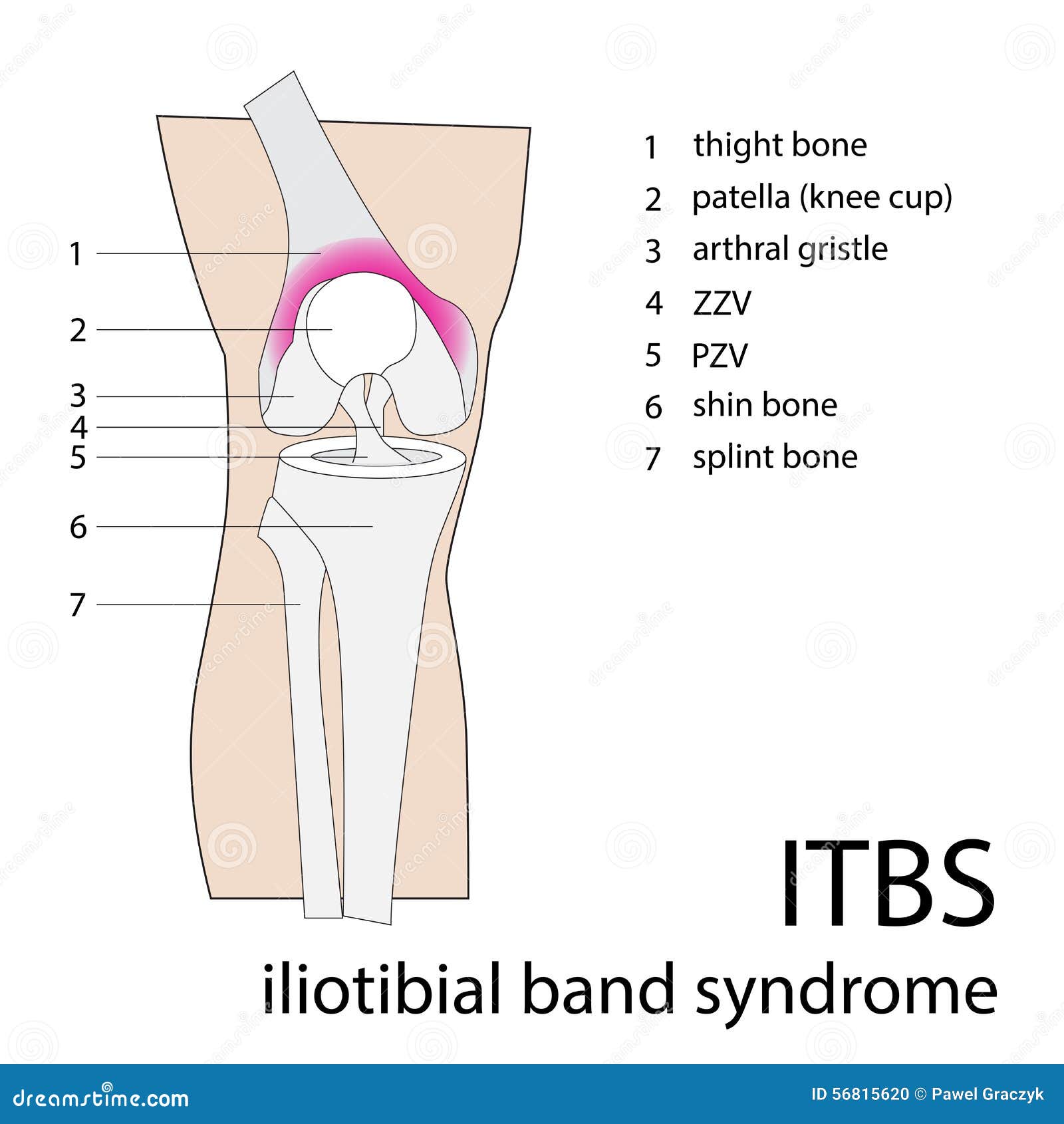 ITB Syndrome