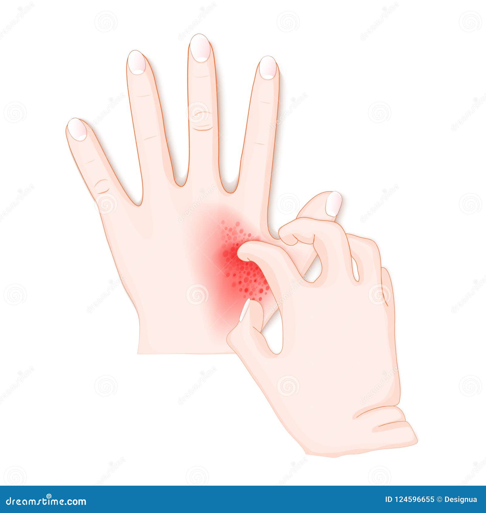 itch. human`s hands with dermatitis