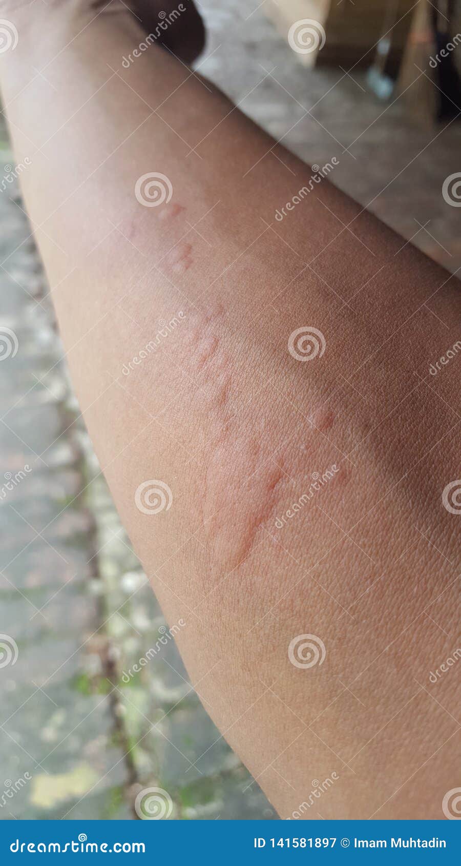 Itchy Bumps On The Skin Due To Insect Bitesitchy Bumps On The Skin Due To Insect Bites Stock Image Image Of Close Illness