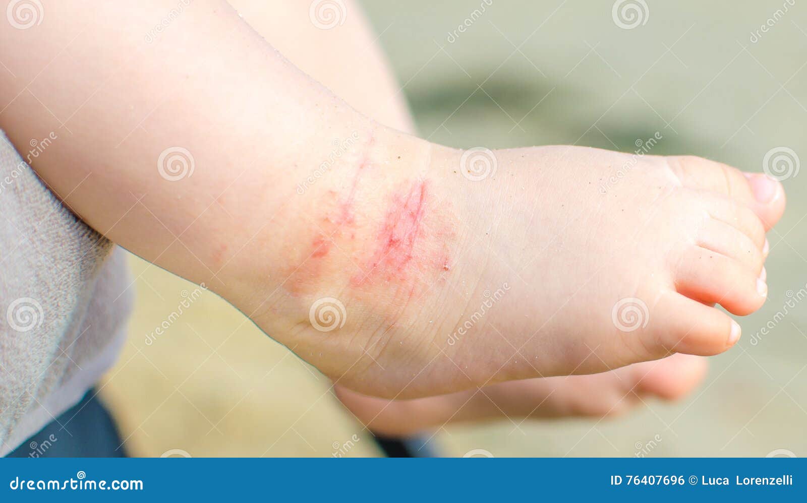 itchy dermatitis atopic baby foot