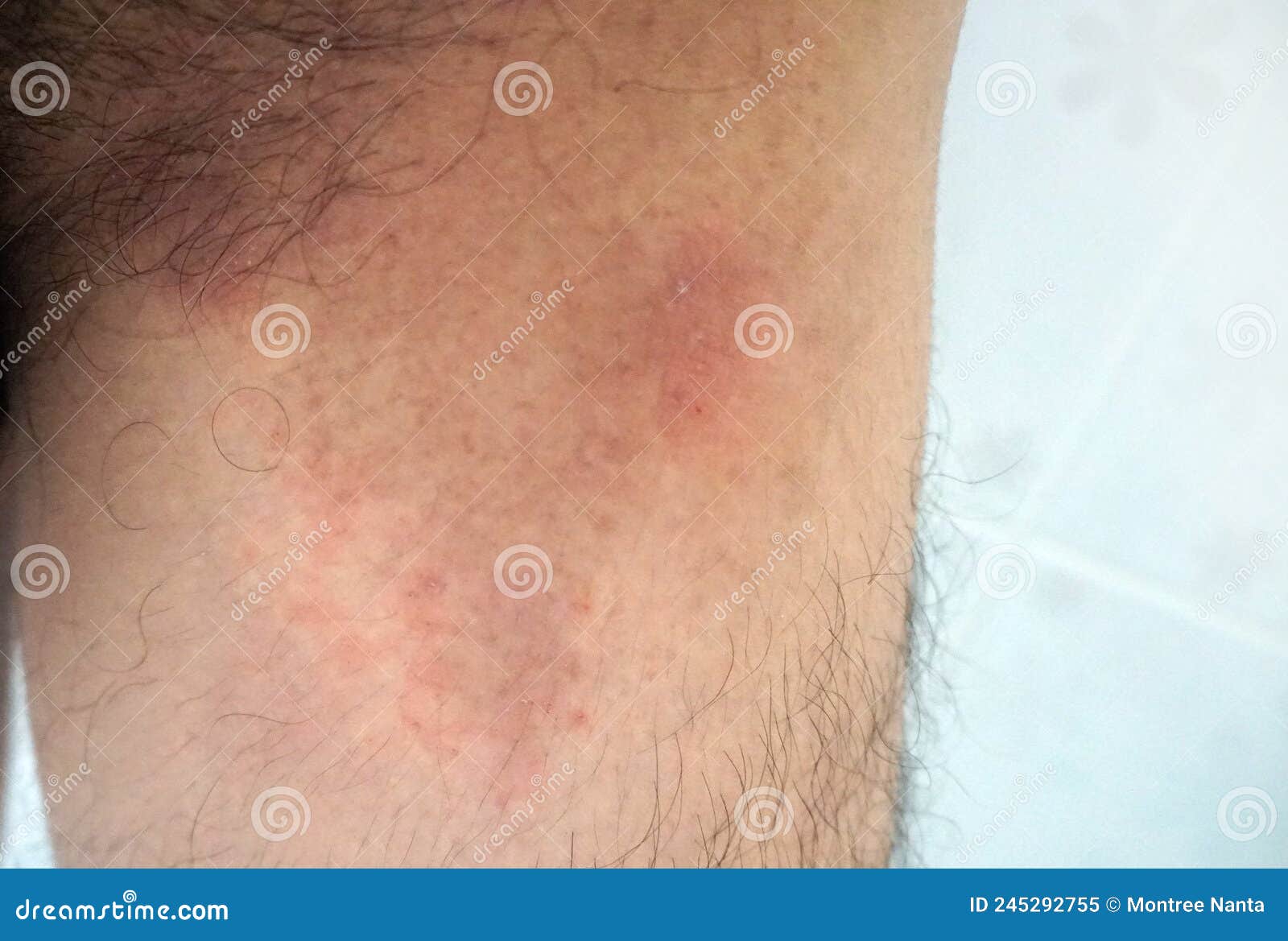 Itchy Rash In The Groin Area Tinea Cruris Is A Type Of Skin Disease