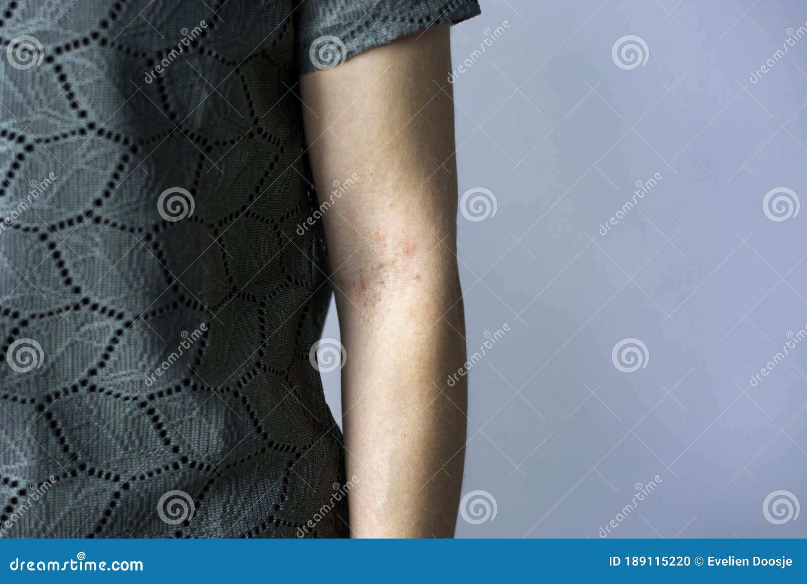 Red Itchy Bumps On Skin Arms