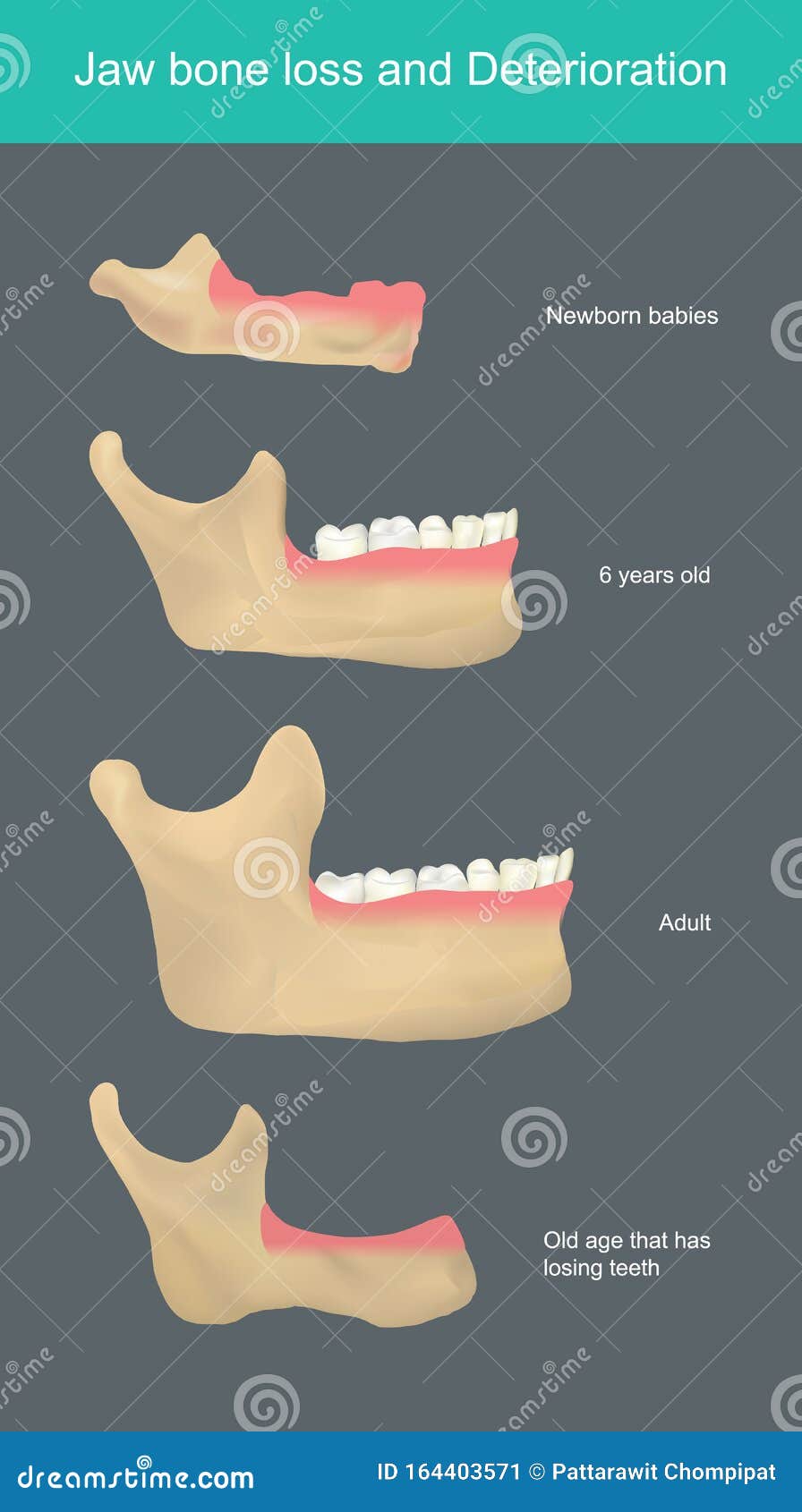jaw bone loss and deterioration. .