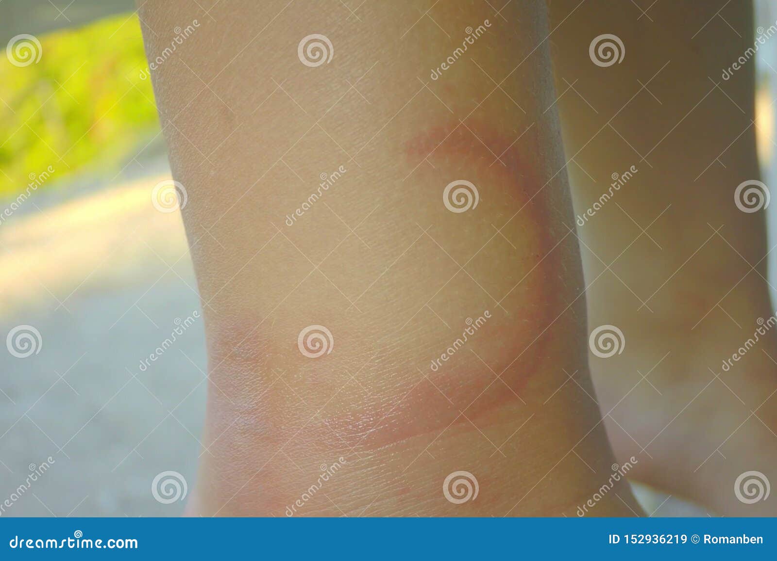 Jelly Fish ,jellyfish Wound Bite on Child`s Leg. Pelagia Noctiluca