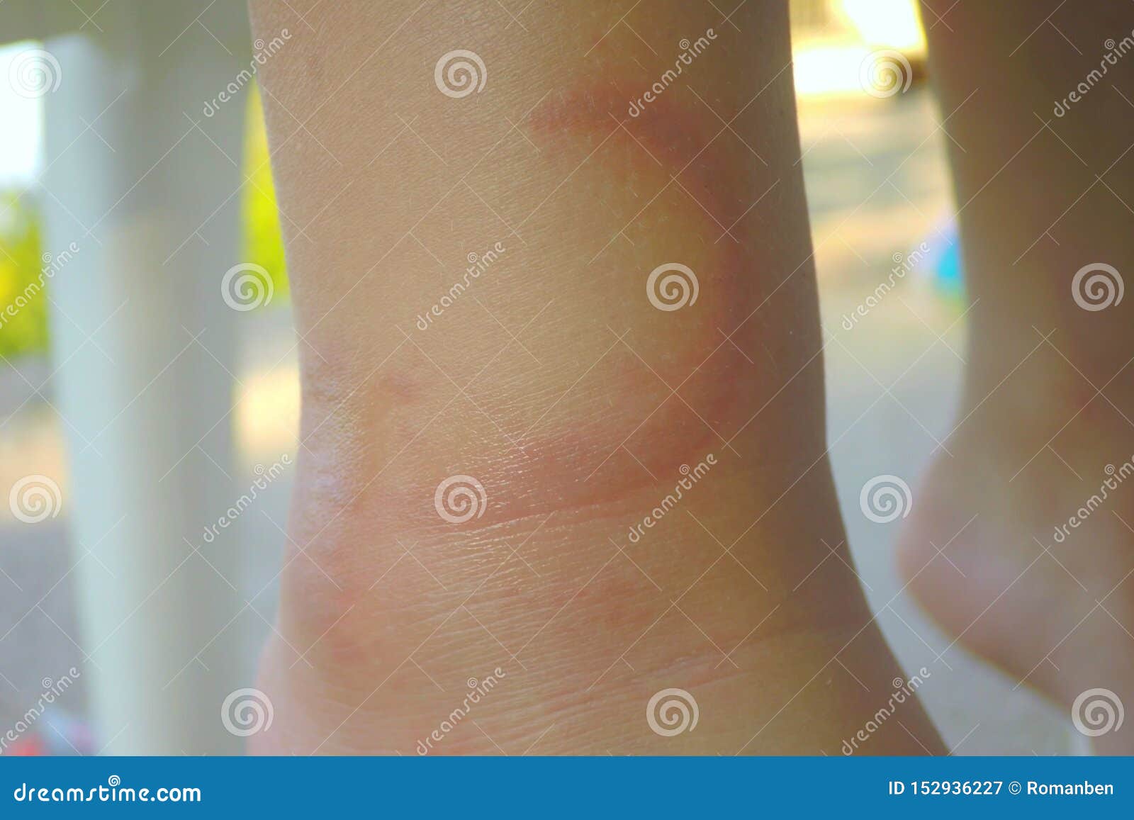 Bte of Jellyfish. Jelly Fish Marks on a Human Body Stock Image - Image of  pain, human: 152936227