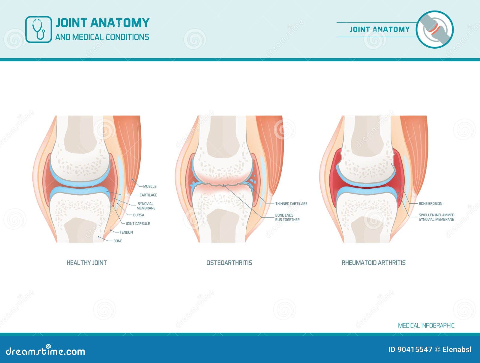 joint anatomy, osteoarthritis and rheumatoid arthritis infographic