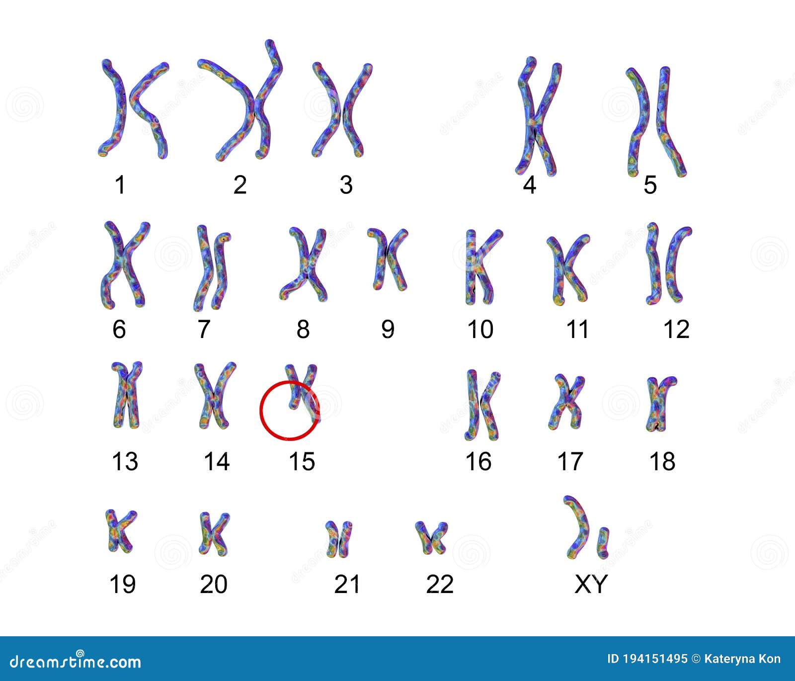 karyotype of angelman syndrome