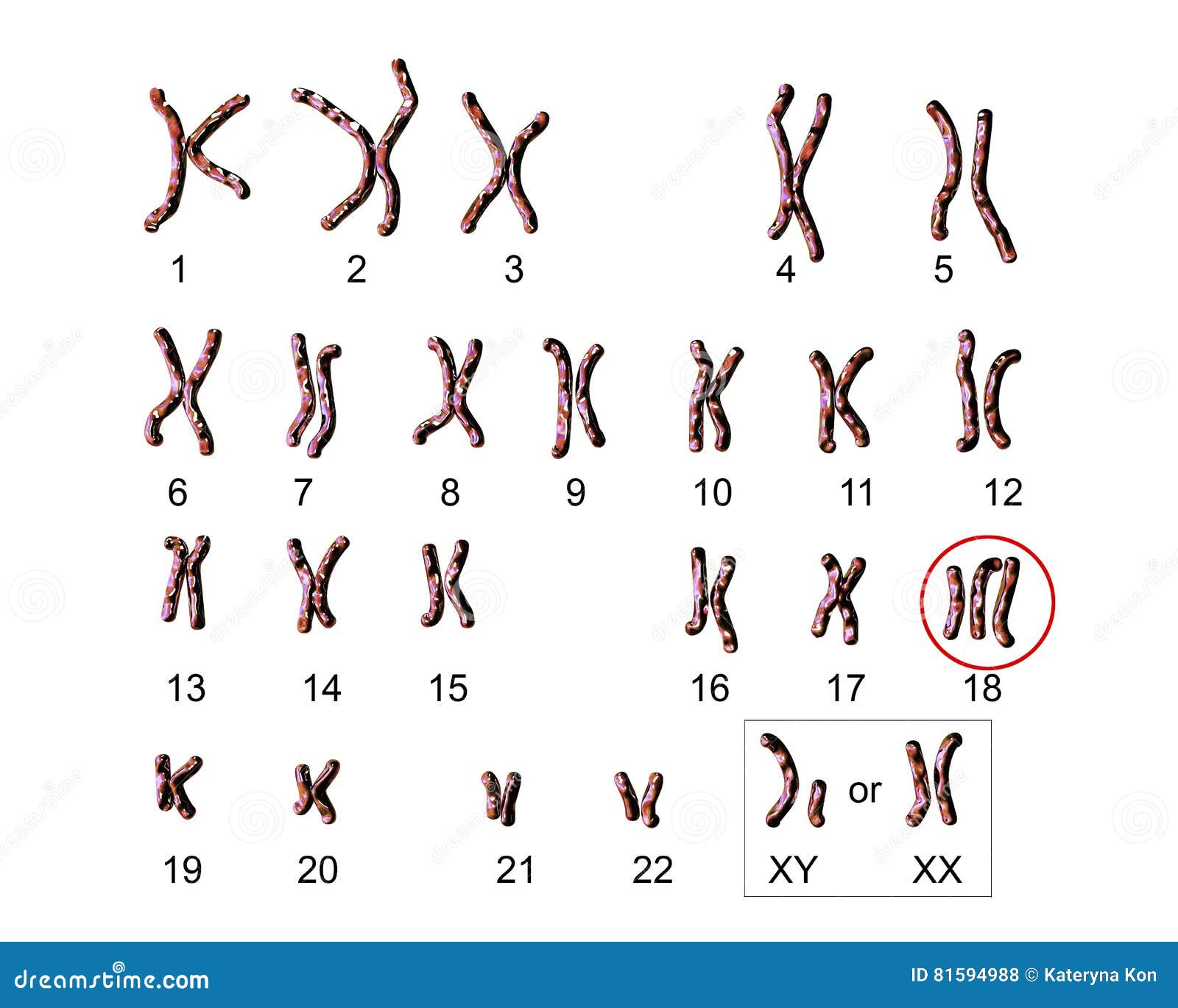 Karyotype D'Edwardssyndrome Illustration Stock Illustration du