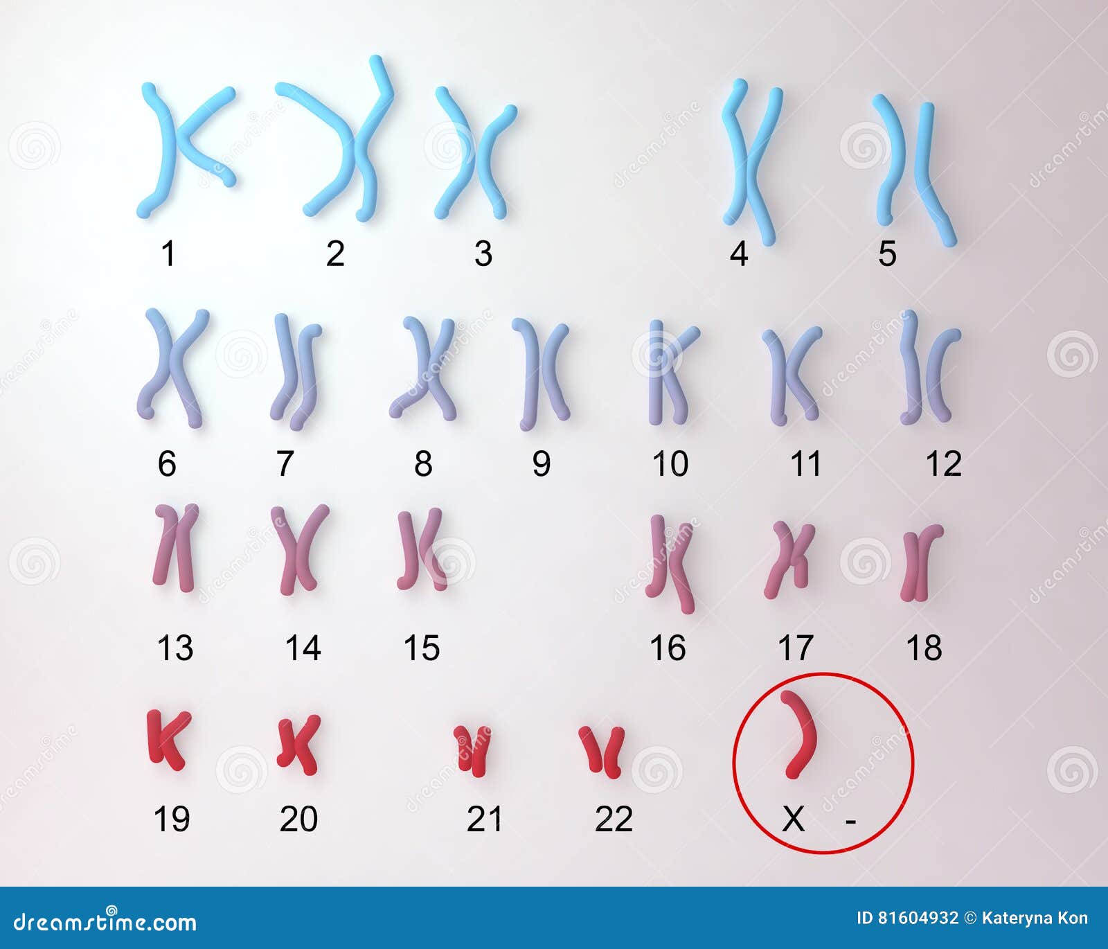 Karyotype Da Ssíndrome De Turner Ilustração Stock Ilustração de