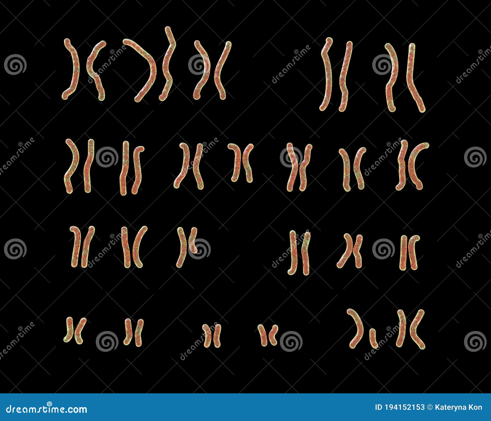 karyotype of prader-willi syndrome