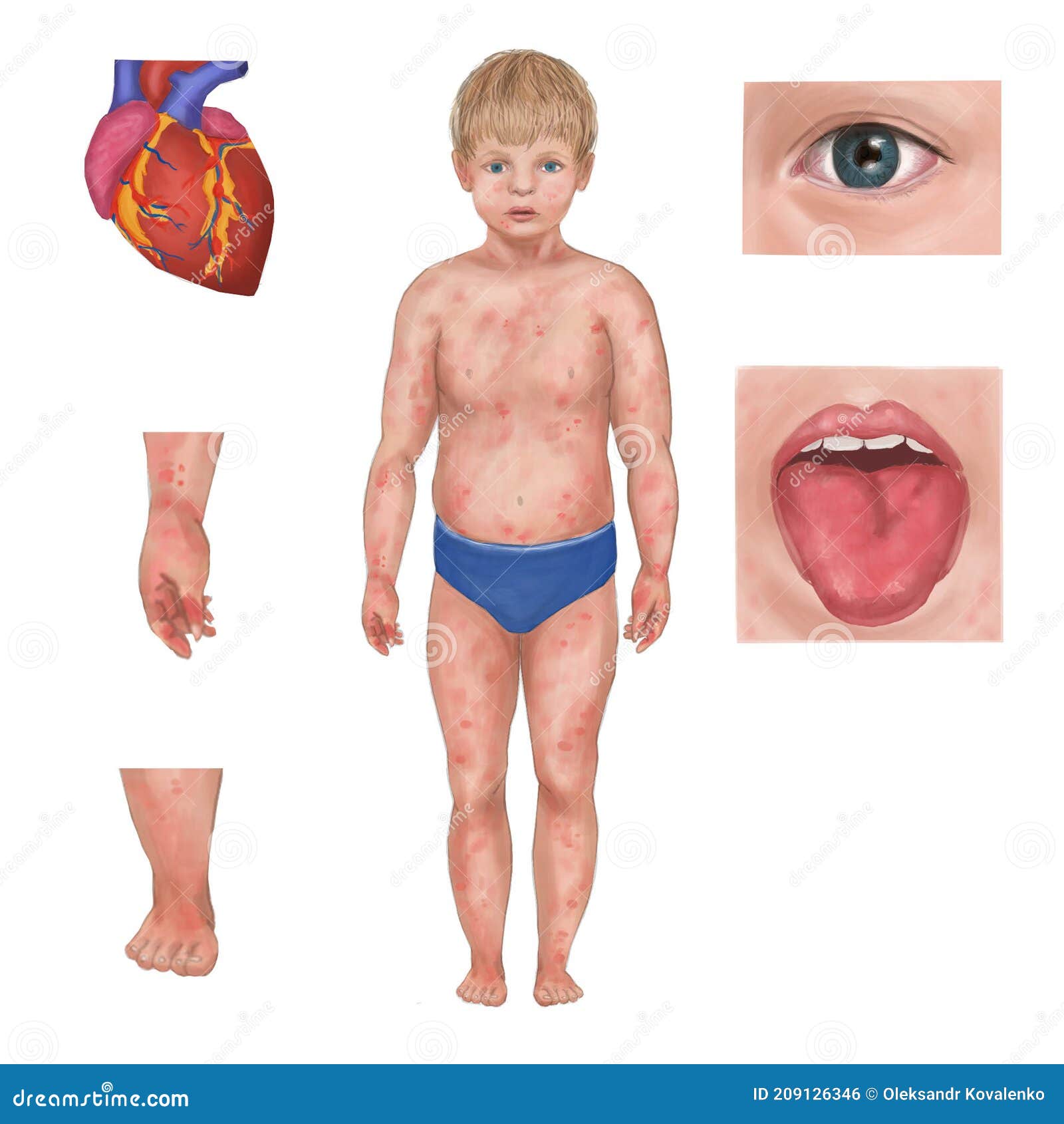 Kawasaki Disease Common of Kawasaki Syndrome - Illustration of rashes, reare: 209126346