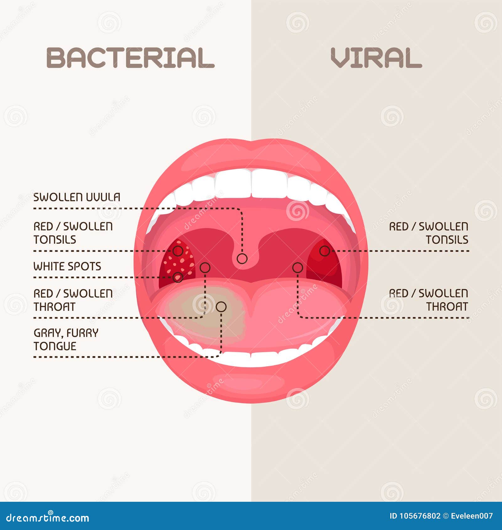 Keel Bacteriële Besmetting, Amandelenontsteking Vector Illustratie -  Illustration Of Open, Ademhalings: 105676802
