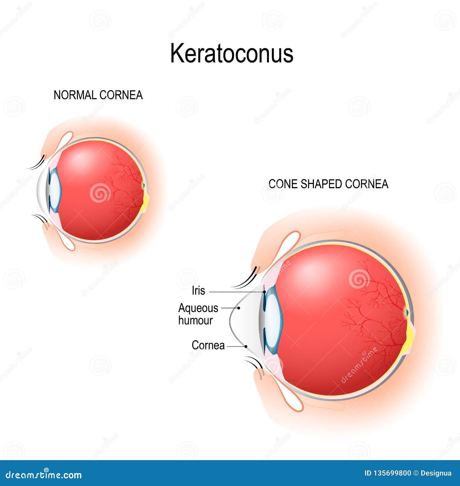 keratoconus. normal cornea and cone d cornea