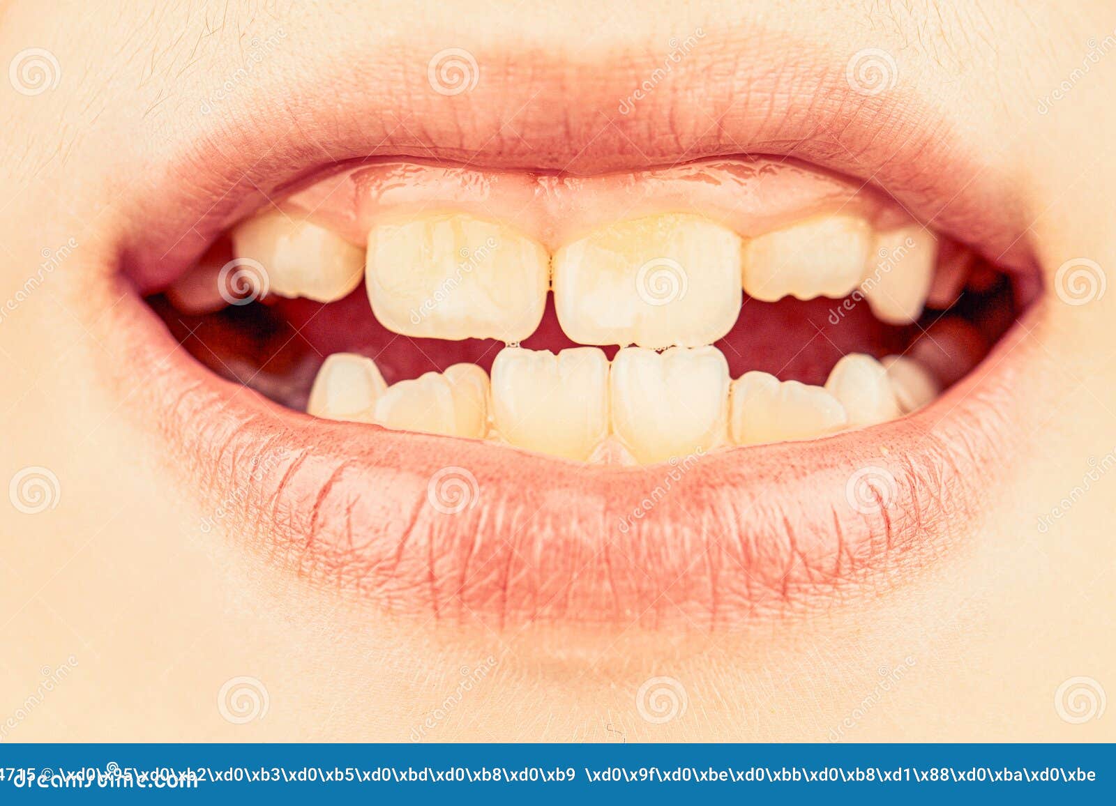 Kid Patient Open Mouth Showing Cavities Teeth Decay. Bad Teeth Child