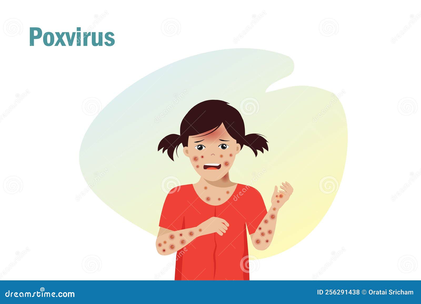 kid suffering from poxvirus symptom, raches skin, headache and fever. for awareness in spreading of orthopoxvirus outbreak