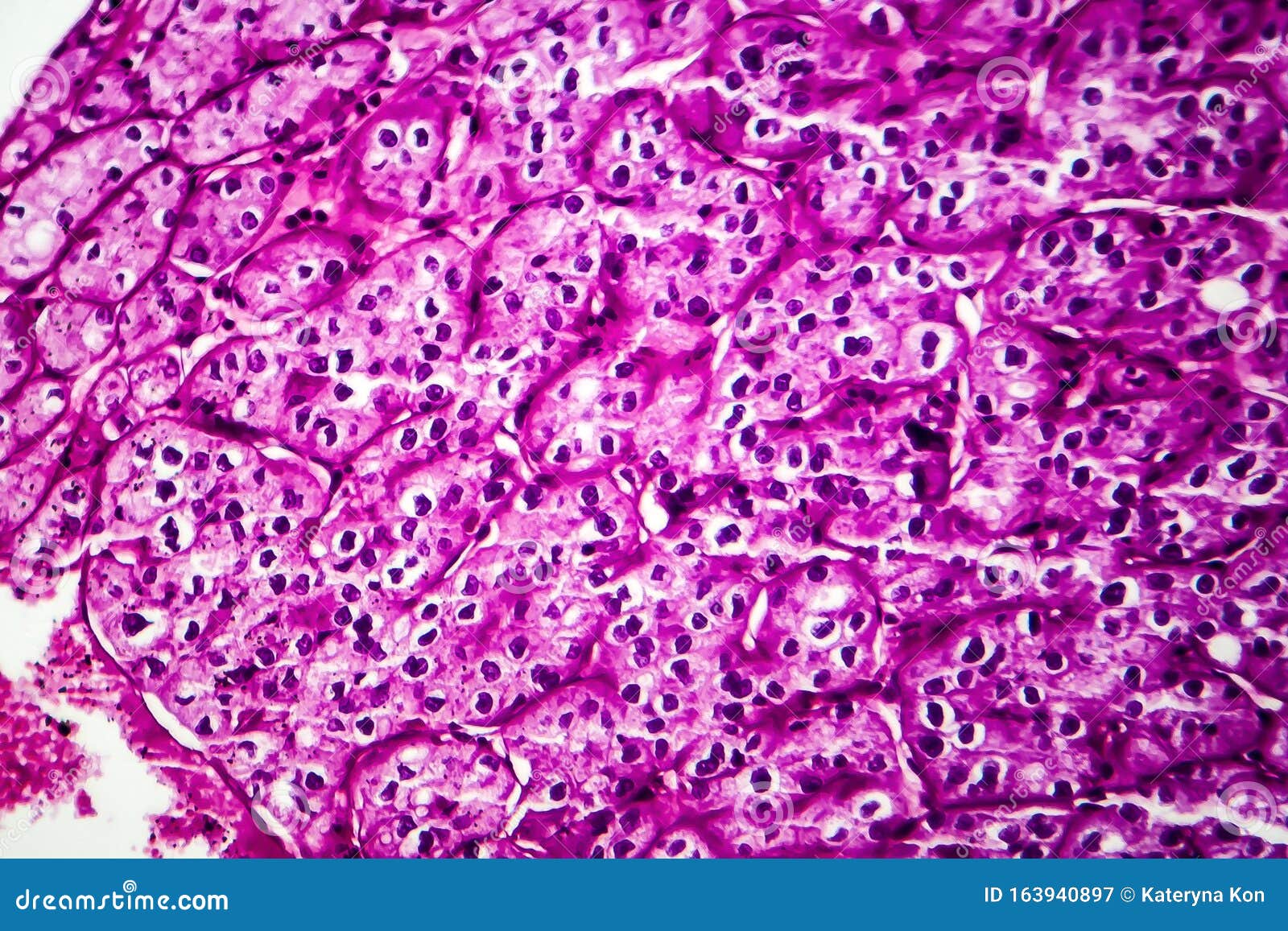 Kidney Cancer, Light Micrograph Stock Image Image of malignant