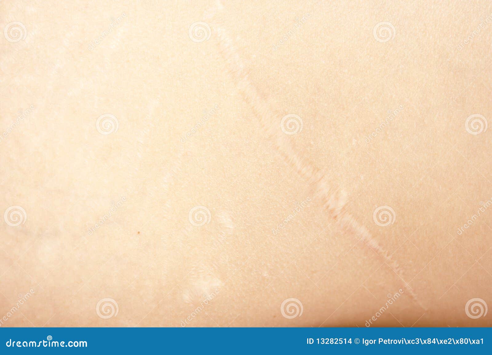 Kidney Operation Scar Stock Photo Image Of Woman Scar 13282514