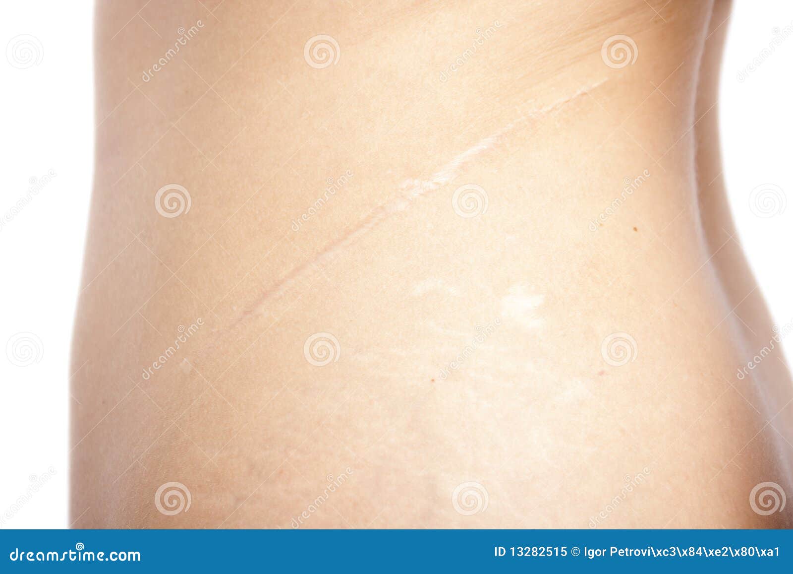 Kidney Operation Scar Royalty Free Stock Photo Image 13282515
