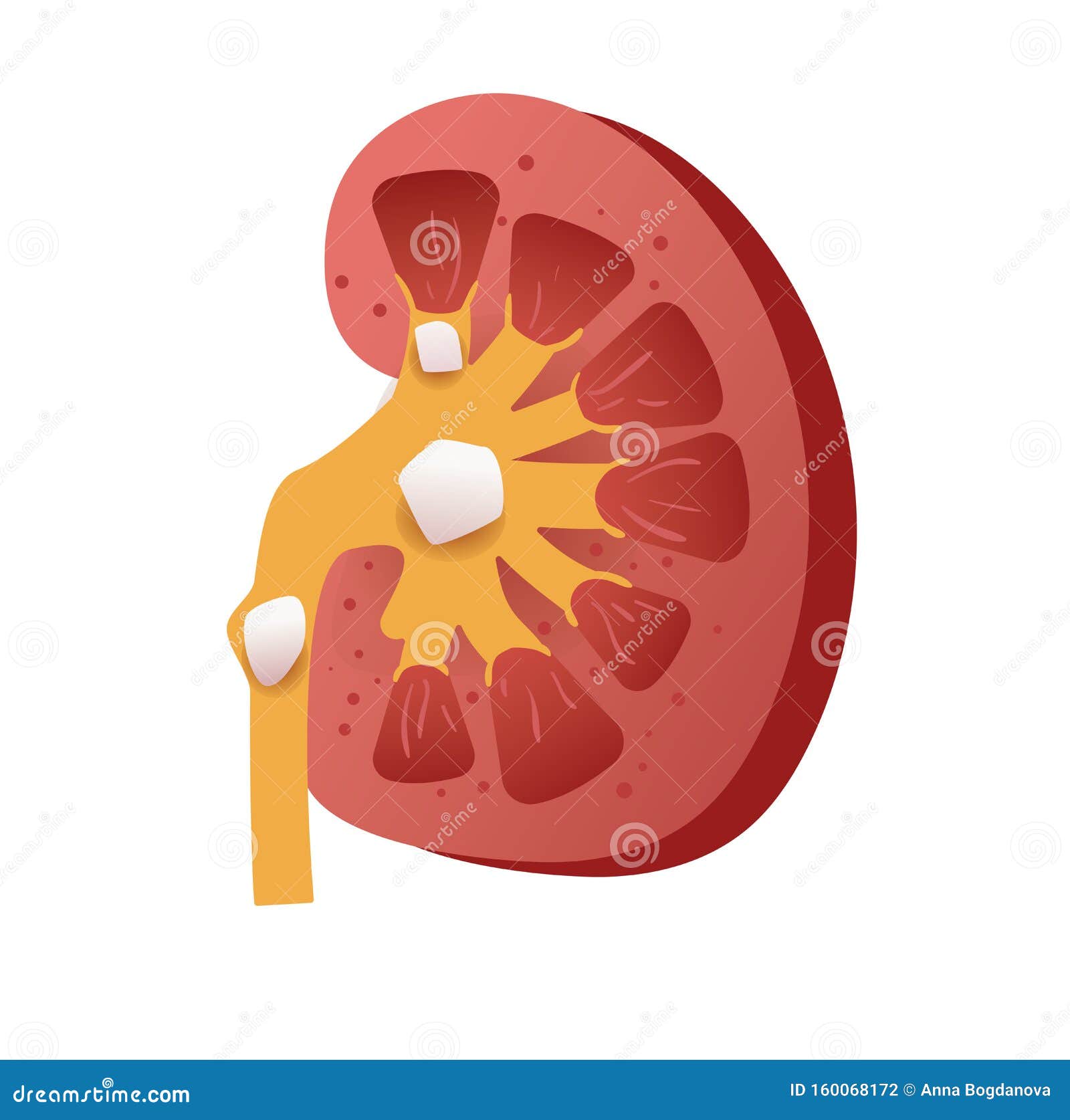 Kidney Stone Disease Vector. Cartoon. Isolated Art on White Background.  Flat Stock Vector - Illustration of nephropathy, organ: 160068172