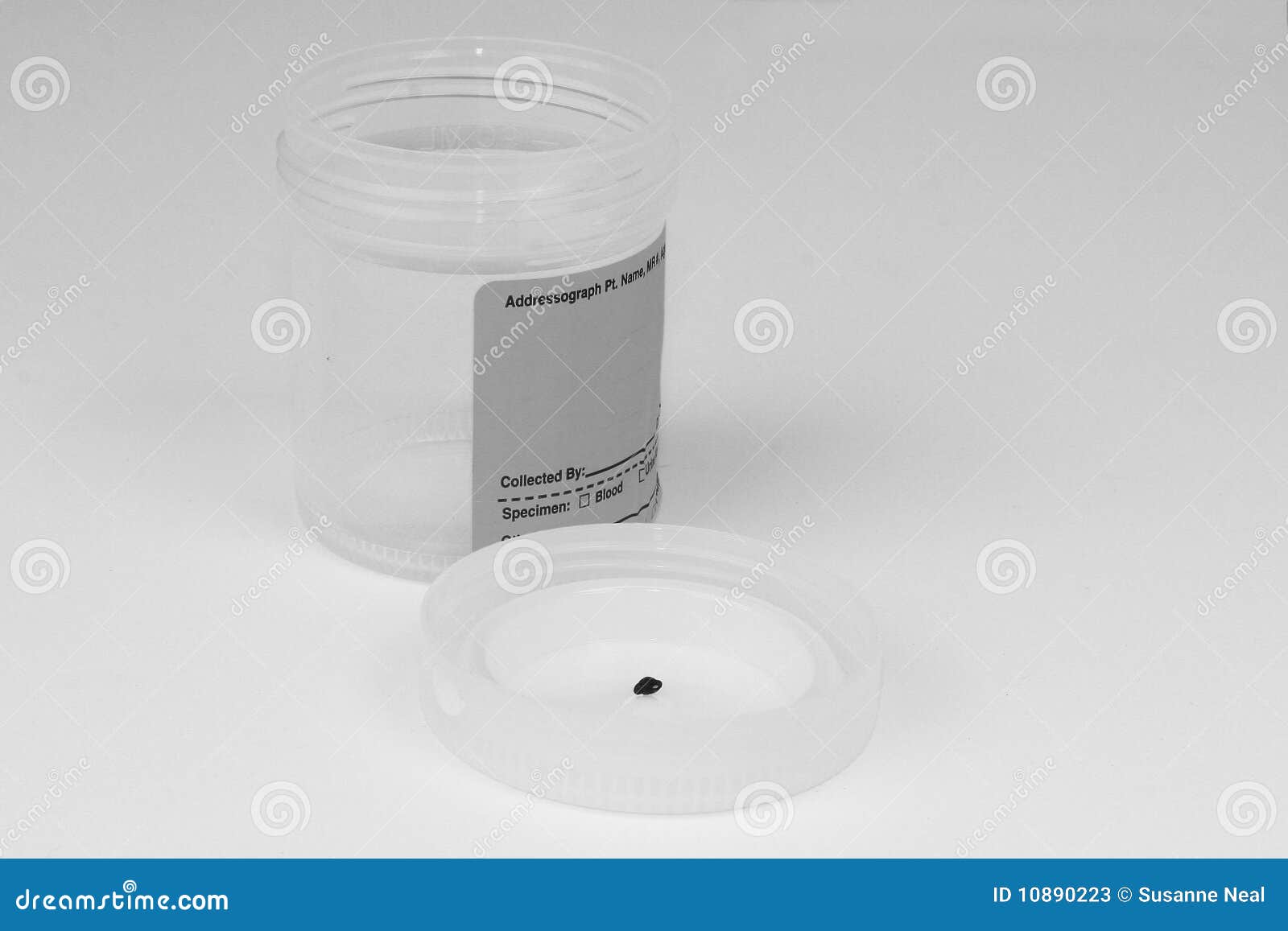 kidney stone in lid of specimen cup