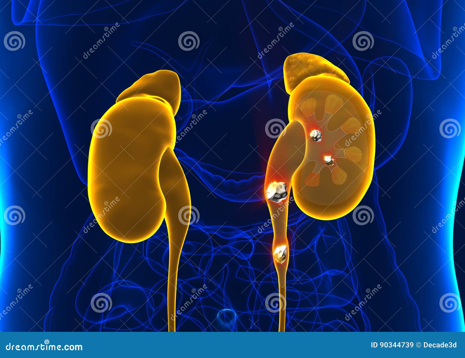 kidney stones anatomy pain male internal organ painful cristaline mineral cross section - 3d 