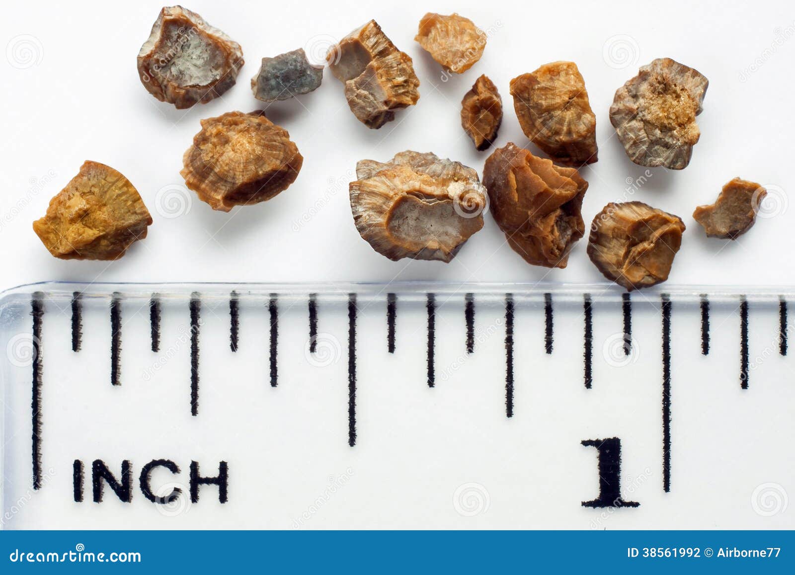 Kidney stones stock photo. Image of disease, failure 38561992