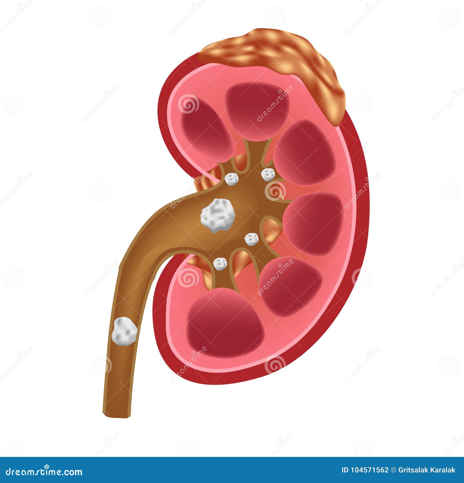 Kidney Stones Medical Concept Vector . Anatomy | CartoonDealer.com