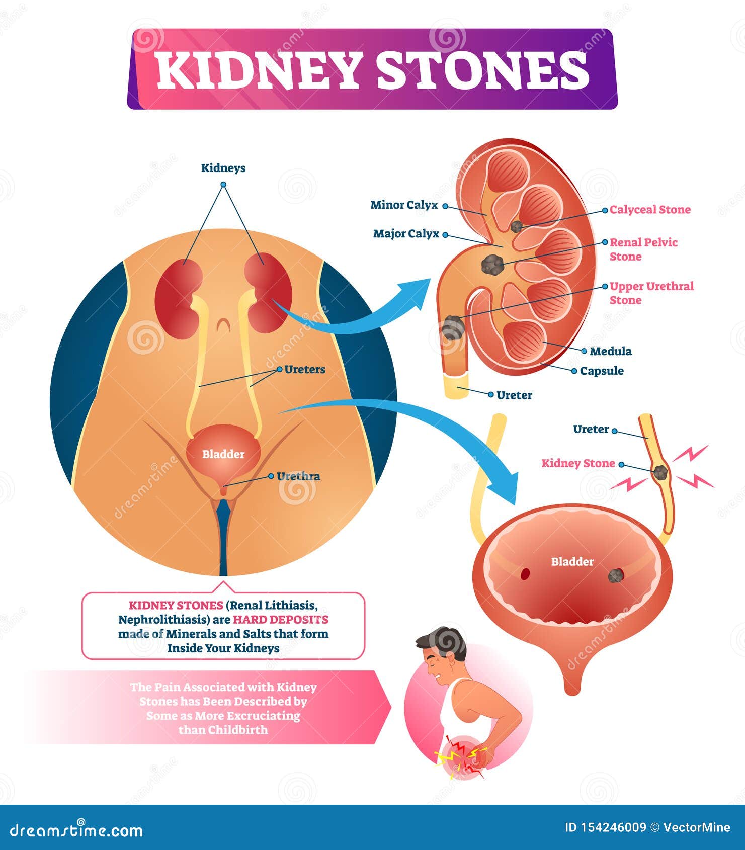 kidney stones  . labeled internal hard deposits disease.