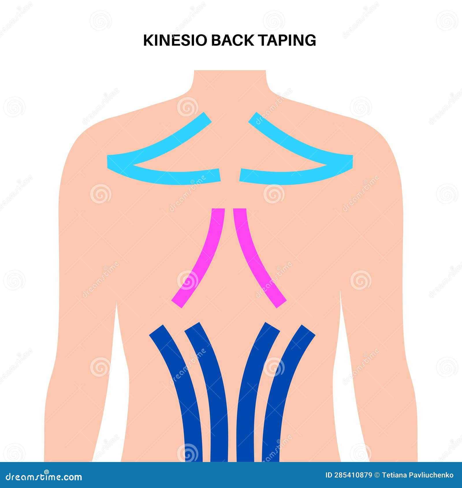 Kinesiology Therapeutic Tape Stock Illustration Illustration of spine