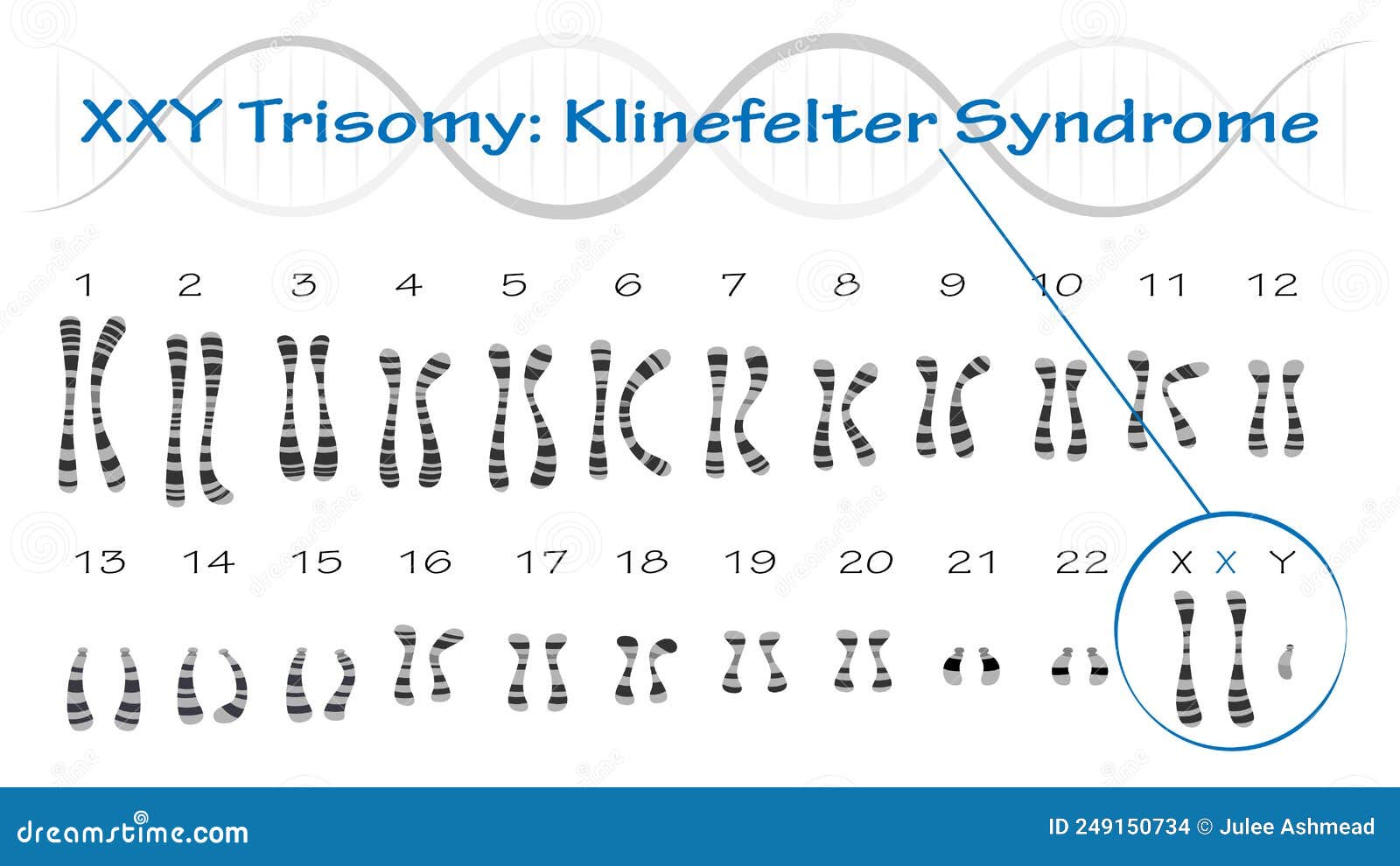 Klinefelter Syndrome Karyotype Vector Illustration Xxy Trisomy Stock