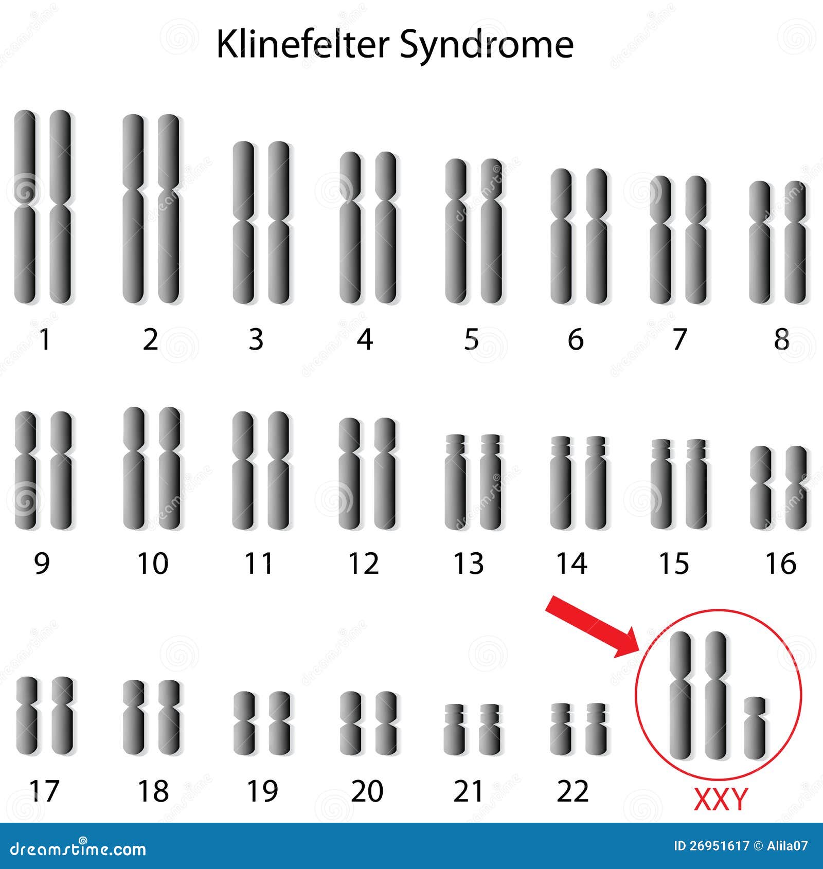 Klinefelter Syndrome Stock Vector Illustration Of Chromosomal 26951617