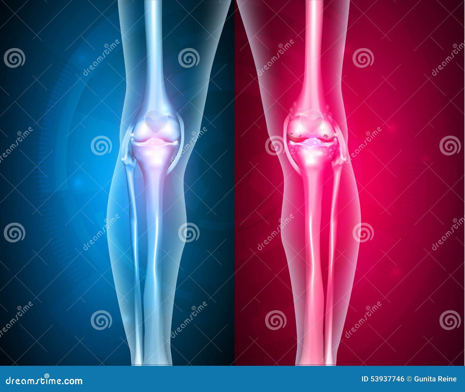 knee joints healthy and unhealthy